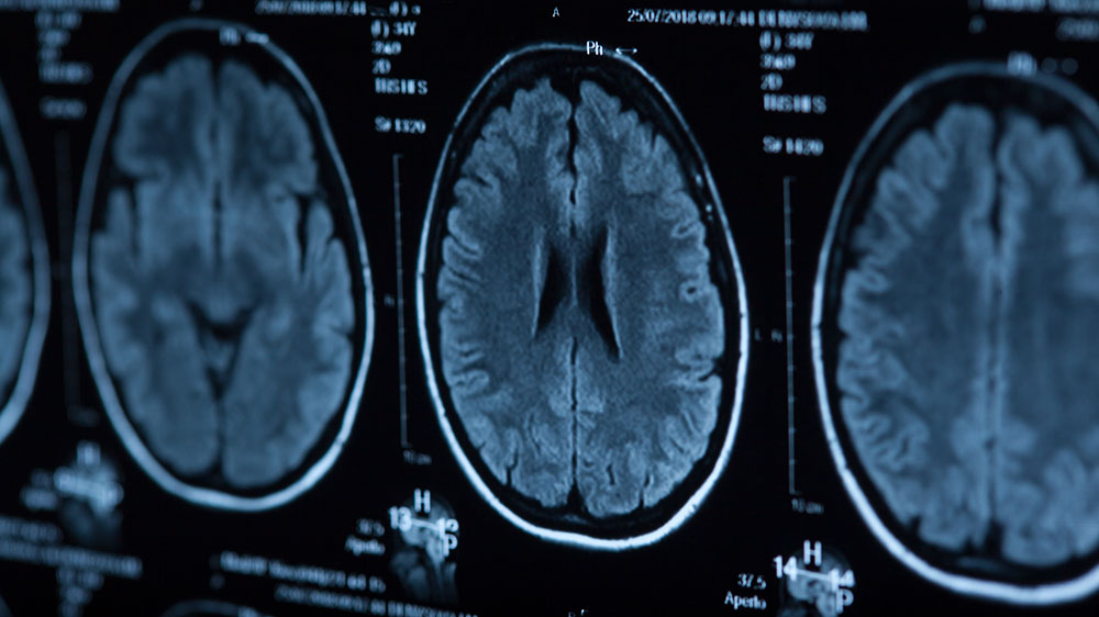 røntgenbilde av hjerne