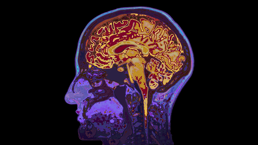 MS illustrasjon i hjernen