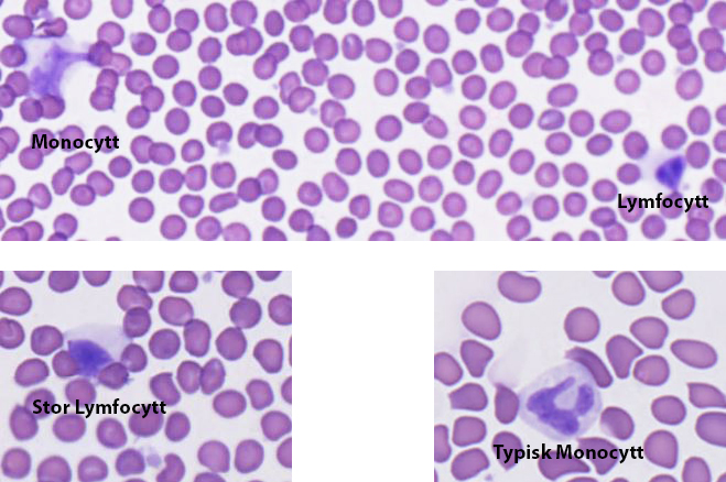 Eksempler på Monocytt vs lymfocytt